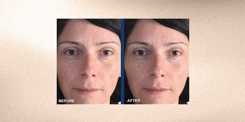 Before and after picture of woman's skin after using retinol